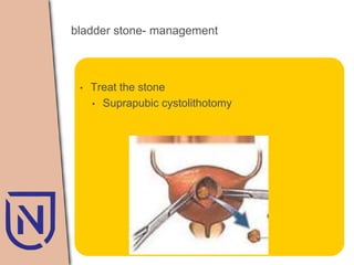 Baldder calculi neo | PPTX