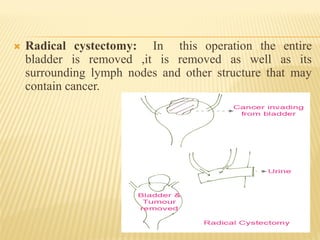  Radical cystectomy: In this operation the entire
bladder is removed ,it is removed as well as its
surrounding lymph nodes and other structure that may
contain cancer.
 