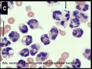 BAL neutrophil predomnance with intracellular bacteria
 