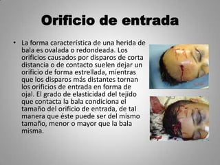 Orificio de entrada
• La forma característica de una herida de
  bala es ovalada o redondeada. Los
  orificios causados por disparos de corta
  distancia o de contacto suelen dejar un
  orificio de forma estrellada, mientras
  que los disparos más distantes tornan
  los orificios de entrada en forma de
  ojal. El grado de elasticidad del tejido
  que contacta la bala condiciona el
  tamaño del orificio de entrada, de tal
  manera que éste puede ser del mismo
  tamaño, menor o mayor que la bala
  misma.
 