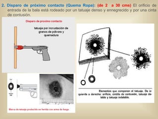 2. Disparo de próximo contacto (Quema Ropa): (de 2 a 30 cms) El orificio de 
entrada de la bala está rodeado por un tatuaje denso y ennegrecido y por una cinta 
de contusión. 
 