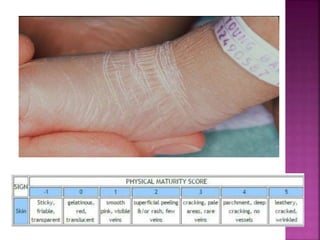 Ballard Inconsistent Ballard scale presentation | PPTX