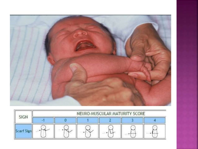What Are The Components Of Ballard Scale? – JXLHA