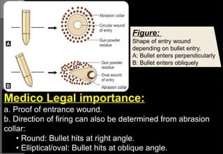 Medico Legal importance:
a. Proof of entrance wound.
b. Direction of firing can also be determined from abrasion
collar:
• Round: Bullet hits at right angle.
• Elliptical/oval: Bullet hits at oblique angle.
Figure:
Shape of entry wound
depending on bullet entry.
A: Bullet enters perpendicularly
B: Bullet enters obliquely
 