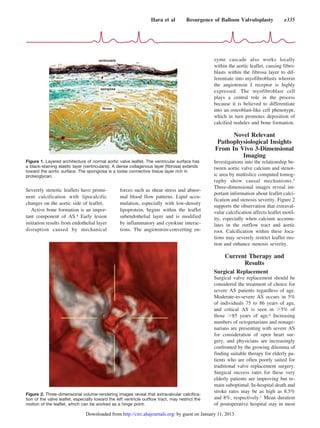 Severely stenotic leaflets have promi-
nent calcification with lipocalcific
changes on the aortic side of leaflet.
Active bone formation is an impor-
tant component of AS.4 Early lesion
initiation results from endothelial layer
disruption caused by mechanical
forces such as shear stress and abnor-
mal blood flow patterns. Lipid accu-
mulation, especially with low-density
lipoprotein, begins within the leaflet
subendothelial layer and is modified
by inflammatory and cytokine interac-
tions. The angiotensin-converting en-
zyme cascade also works locally
within the aortic leaflet, causing fibro-
blasts within the fibrosa layer to dif-
ferentiate into myofibroblasts wherein
the angiotensin I receptor is highly
expressed. The myofibroblast cell
plays a central role in the process
because it is believed to differentiate
into an osteoblast-like cell phenotype,
which in turn promotes deposition of
calcified nodules and bone formation.
Novel Relevant
Pathophysiological Insights
From In Vivo 3-Dimensional
Imaging
Investigations into the relationship be-
tween aortic valve calcium and stenot-
ic area by multislice computed tomog-
raphy show causal mechanisms.5
Three-dimensional images reveal im-
portant information about leaflet calci-
fication and stenosis severity. Figure 2
supports the observation that extraval-
vular calcification affects leaflet motil-
ity, especially when calcium accumu-
lates in the outflow tract and aortic
root. Calcification within these loca-
tions may severely restrict leaflet mo-
tion and enhance stenosis severity.
Current Therapy and
Results
Surgical Replacement
Surgical valve replacement should be
considered the treatment of choice for
severe AS patients regardless of age.
Moderate-to-severe AS occurs in 5%
of individuals 75 to 86 years of age,
and critical AS is seen in Ͼ5% of
those Ͼ85 years of age.6 Increasing
numbers of octogenarians and nonage-
narians are presenting with severe AS
for consideration of open heart sur-
gery, and physicians are increasingly
confronted by the growing dilemma of
finding suitable therapy for elderly pa-
tients who are often poorly suited for
traditional valve replacement surgery.
Surgical success rates for these very
elderly patients are improving but re-
main suboptimal. In-hospital death and
stroke rates may be as high as 8.5%
and 8%, respectively.1 Mean duration
of postoperative hospital stay in most
Figure 1. Layered architecture of normal aortic valve leaﬂet. The ventricular surface has
a black-staining elastic layer (ventricularis). A dense collagenous layer (ﬁbrosa) extends
toward the aortic surface. The spongiosa is a loose connective tissue layer rich in
proteoglycan.
Figure 2. Three-dimensional volume-rendering images reveal that extravalvular calciﬁca-
tion of the valve leaﬂet, especially toward the left ventricle outﬂow tract, may restrict the
motion of the leaﬂet, which can be worked as a hinge point.
Hara et al Resurgence of Balloon Valvuloplasty e335
by guest on January 11, 2013http://circ.ahajournals.org/Downloaded from
 