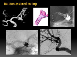 Coiling Assisted Balloon Assisted Coiling | PPTX