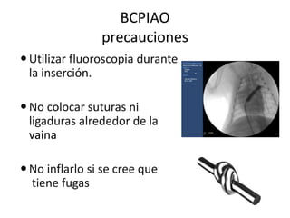 BCPIAO
precauciones
 Utilizar fluoroscopia durante
la inserción.
 No colocar suturas ni
ligaduras alrededor de la
vaina

 No inflarlo si se cree que
tiene fugas

 