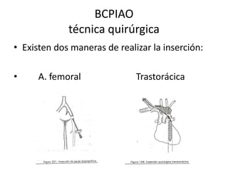 BCPIAO
técnica quirúrgica
• Existen dos maneras de realizar la inserción:
•

A. femoral

Trastorácica

 