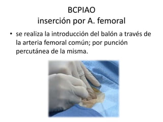 BCPIAO
inserción por A. femoral
• se realiza la introducción del balón a través de
la arteria femoral común; por punción
percutánea de la misma.

 