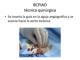 BCPIAO
técnica quirúrgica
• Se inserta la guía en la aguja angiografíca y se
avanza hacia la aorta torácica.

 