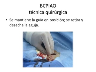 BCPIAO
técnica quirúrgica
• Se mantiene la guía en posición; se retira y
desecha la aguja.

 