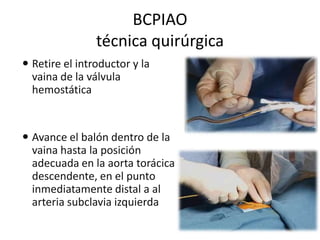 BCPIAO
técnica quirúrgica
 Retire el introductor y la
vaina de la válvula
hemostática

 Avance el balón dentro de la
vaina hasta la posición
adecuada en la aorta torácica
descendente, en el punto
inmediatamente distal a al
arteria subclavia izquierda

 
