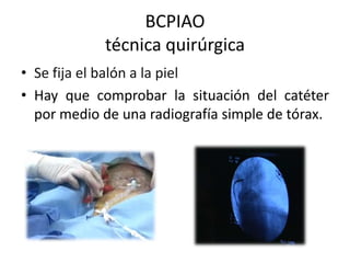 BCPIAO
técnica quirúrgica
• Se fija el balón a la piel
• Hay que comprobar la situación del catéter
por medio de una radiografía simple de tórax.

 