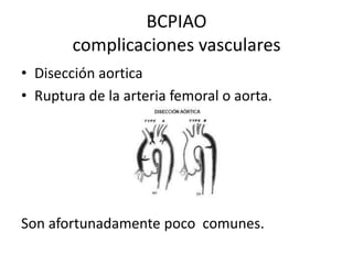 BCPIAO
complicaciones vasculares
• Disección aortica
• Ruptura de la arteria femoral o aorta.

Son afortunadamente poco comunes.

 