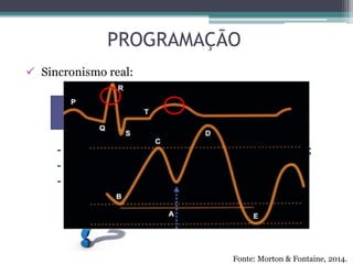 PROGRAMAÇÃO
 Sincronismo real:
- Reconhecimento automático do complexo QRS;
- Insuflação no meio da onda T;
- Deflação automática ao identificar onda R;
Fonte: Morton & Fontaine, 2014.
Mecanismo de gatilho: sinal de ECG
 