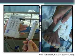 CUIDADOS DE ENFERMAGEM
Integridade neurovascular do membro distal
• Avaliação periódica dos pulsos periféricos por
palpação ou Doppler, determinação de temperatura,
cor, enchimento capilar e função sensorial;
• 1/1 hora e 1-2 horas;
DC, uso de vasopressores,
hipotermia
Fonte: SMELTZER, BARE, 2012; Woods, 2005.
 