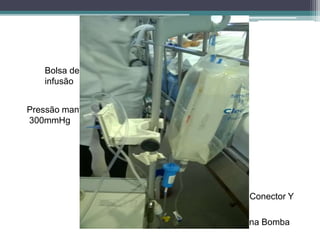 EQUIPAMENTOS
Conector Y
Bolsa de
infusão
Pressão mantida a
300mmHg
Conexão na Bomba
 
