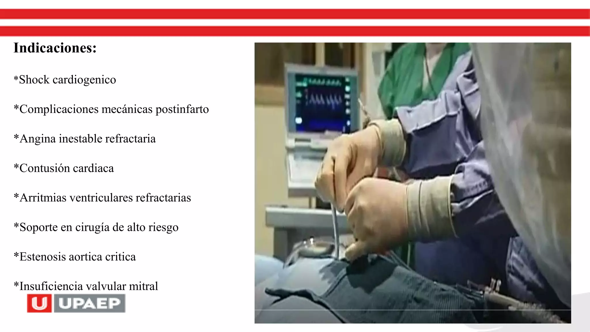 Indicaciones:
*Shock cardiogenico
*Complicaciones mecánicas postinfarto
*Angina inestable refractaria
*Contusión cardiaca
*Arritmias ventriculares refractarias
*Soporte en cirugía de alto riesgo
*Estenosis aortica critica
*Insuficiencia valvular mitral
 