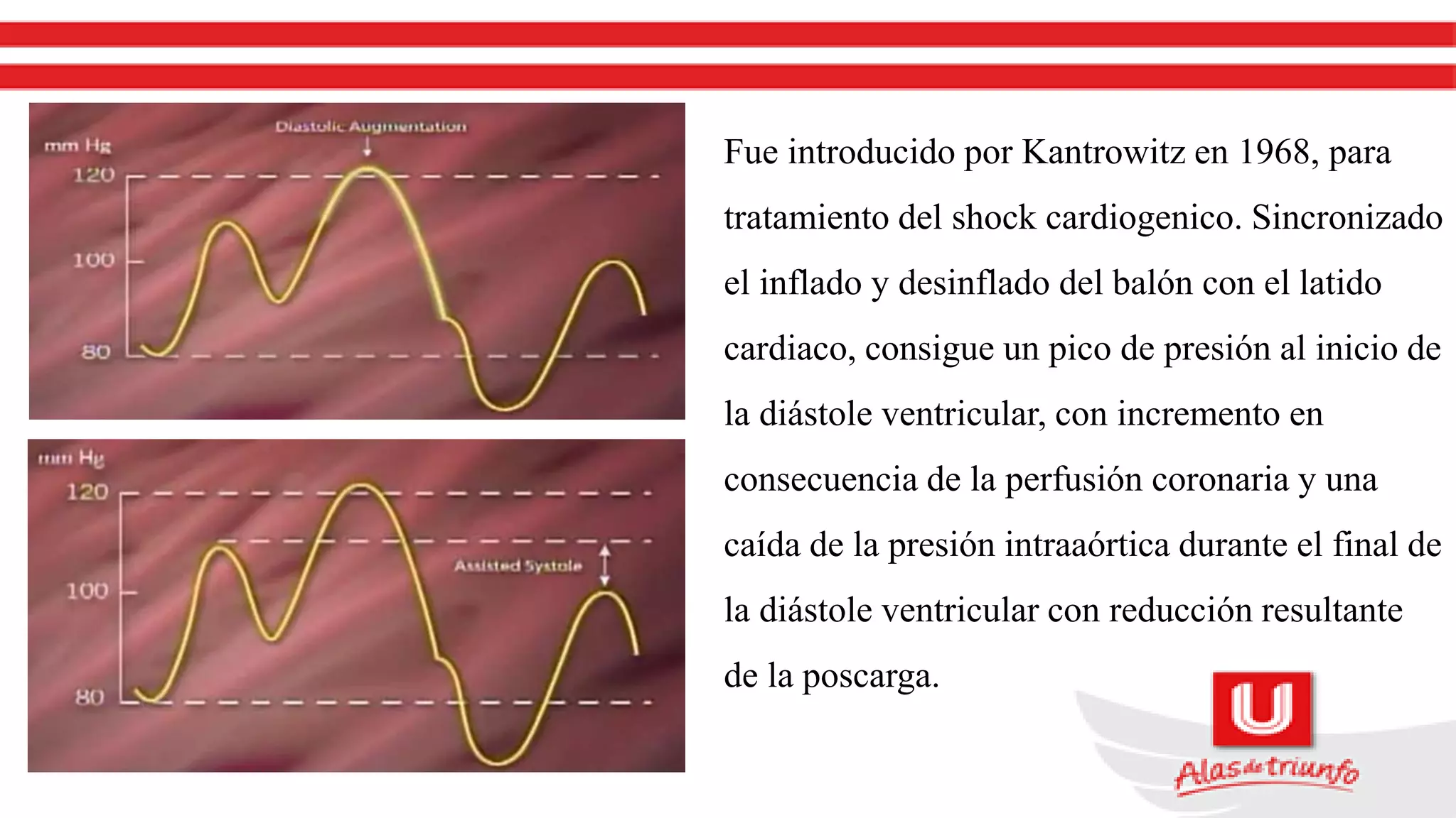 Fue introducido por Kantrowitz en 1968, para
tratamiento del shock cardiogenico. Sincronizado
el inflado y desinflado del balón con el latido
cardiaco, consigue un pico de presión al inicio de
la diástole ventricular, con incremento en
consecuencia de la perfusión coronaria y una
caída de la presión intraaórtica durante el final de
la diástole ventricular con reducción resultante
de la poscarga.
 