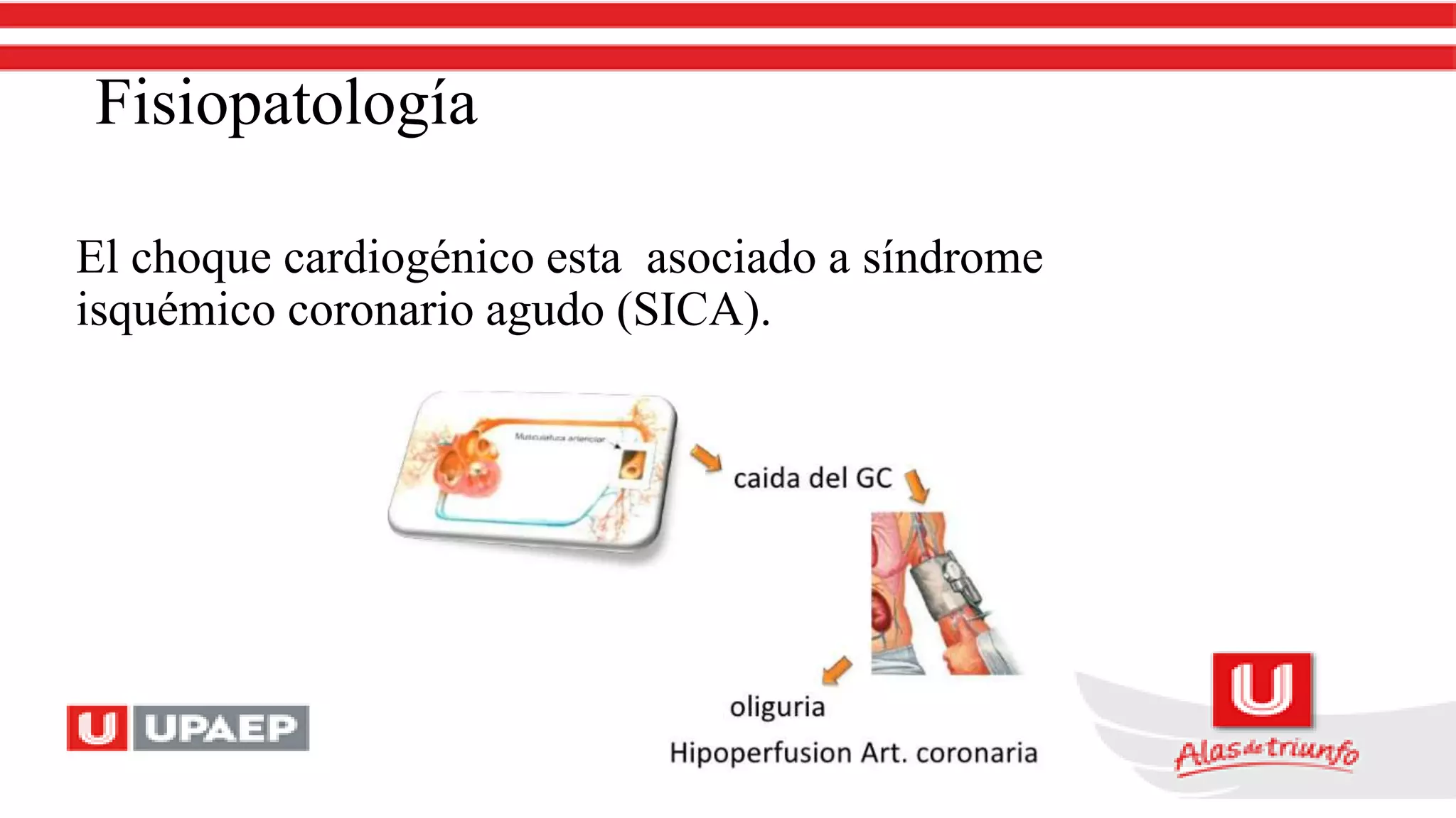 Fisiopatología
El choque cardiogénico esta asociado a síndrome
isquémico coronario agudo (SICA).
 
