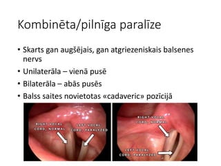 Kombinēta/pilnīga paralīze
• Skarts gan augšējais, gan atgriezeniskais balsenes
nervs
• Unilaterāla – vienā pusē
• Bilaterāla – abās pusēs
• Balss saites novietotas «cadaveric» pozīcijā
 