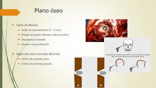 Plano óseo
 Signo de Benassi
 Anillo de ahumamiento (2 – 4 mm)
 Debajo de partes blandas rodea el orifico
 Desaparece al lavado
 Resiste a la putrefacción
 Signo del cono truncado (Bonnet)
 Orifico de entrada chico
 Orificio de entrada grande
 