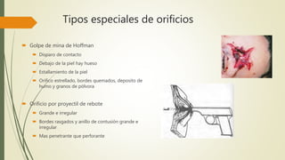Tipos especiales de orificios
 Golpe de mina de Hoffman
 Disparo de contacto
 Debajo de la piel hay hueso
 Estallamiento de la piel
 Orifico estrellado, bordes quemados, deposito de
humo y granos de pólvora
 Orificio por proyectil de rebote
 Grande e irregular
 Bordes rasgados y anillo de contusión grande e
irregular
 Mas penetrante que perforante
 