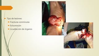  Tipo de lesiones:
 Fracturas conminutas
 Evisceración
 Licuefacción de órganos
 