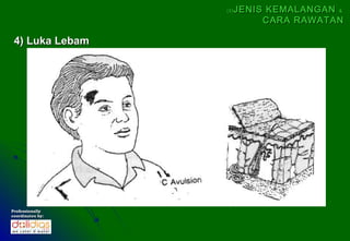(5)   JENIS KEMALANGAN &
                             CARA RAWATAN

 4) Luka Lebam




Professionally
coordinates by:
 