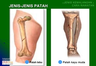 (5)   JENIS KEMALANGAN &
           JENIS-JENIS PATAH                      CARA RAWATAN




Professionally
coordinates by:

                  1   Patah tebu   2    Patah kayu muda
 