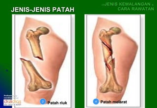 (5)   JENIS KEMALANGAN &
       JENIS-JENIS PATAH                          CARA RAWATAN




Professionally
coordinates by:

                  3
                      Patah riuk   4   Patah melarat
 