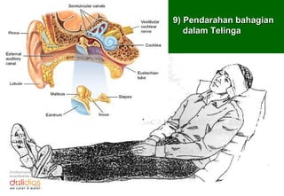 9) Pendarahan bahagian
                     dalam Telinga




Professionally
coordinates by:
 
