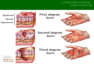 (5)   JENIS KEMALANGAN &
                             CARA RAWATAN




Professionally
coordinates by:
 