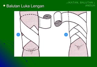  Balutan Luka LenganBalutan Luka Lengan
11 22
(4)(4) IKATAN, BALUTANIKATAN, BALUTAN &&
ANDUHANDUH
 
