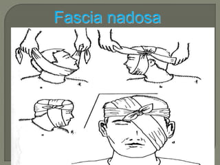 Fascia nadosa 
 