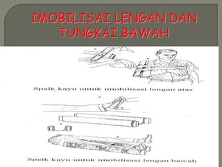 IMOBILISAI LENGAN DAN 
TUNGKAI BAWAH 
 