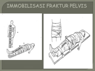 IMMOBILISASI FRAKTUR PELVIS 
 