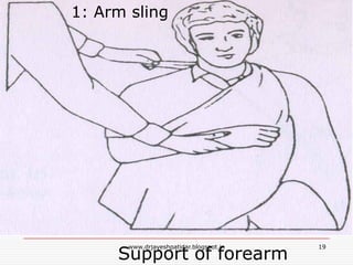 Support of forearm
1: Arm sling
19www.drjayeshpatidar.blogspot.in
 