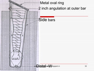 Metal oval ring
2 inch angulation at outer bar
Side bars
Distal -W 32www.drjayeshpatidar.blogspot.in
 