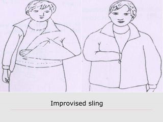 Improvised sling
 