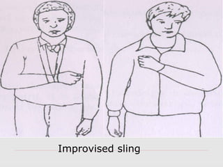Improvised sling
 