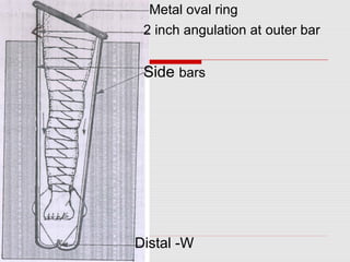 Metal oval ring
2 inch angulation at outer bar
Side bars
Distal -W
 