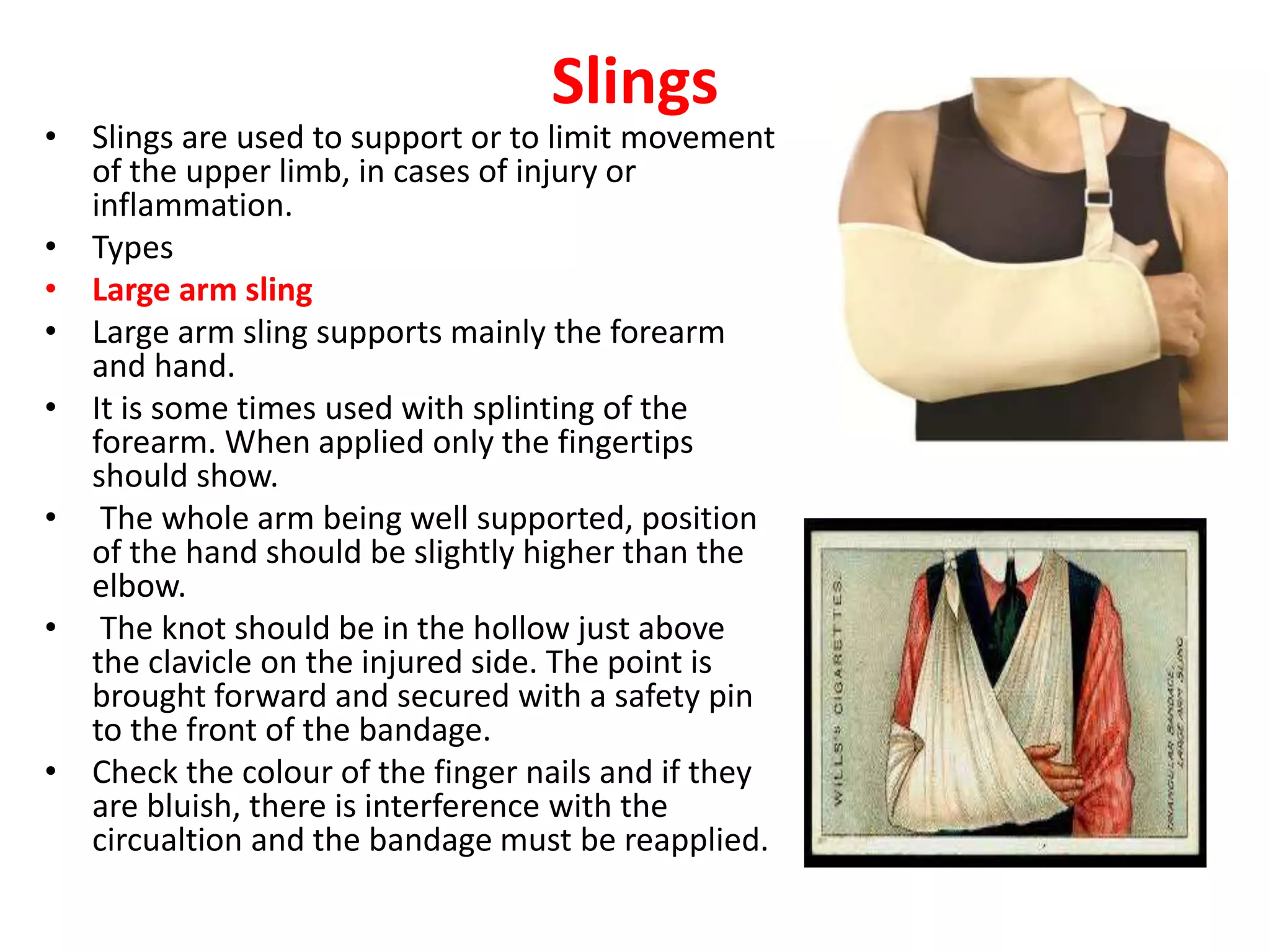 Slings
• Slings are used to support or to limit movement
of the upper limb, in cases of injury or
inflammation.
• Types
• Large arm sling
• Large arm sling supports mainly the forearm
and hand.
• It is some times used with splinting of the
forearm. When applied only the fingertips
should show.
• The whole arm being well supported, position
of the hand should be slightly higher than the
elbow.
• The knot should be in the hollow just above
the clavicle on the injured side. The point is
brought forward and secured with a safety pin
to the front of the bandage.
• Check the colour of the finger nails and if they
are bluish, there is interference with the
circualtion and the bandage must be reapplied.
 