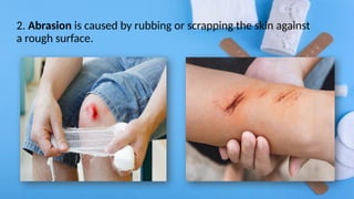 2. Abrasion is caused by rubbing or scrapping the skin against
a rough surface.
 
