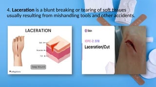 4. Laceration is a blunt breaking or tearing of soft tissues
usually resulting from mishandling tools and other accidents.
 