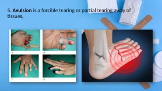 5. Avulsion is a forcible tearing or partial tearing away of
tissues.
 
