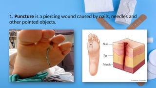 1. Puncture is a piercing wound caused by nails, needles and
other pointed objects.
 