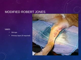 Modified Jones Method Bandaging principles and techniques | PPT