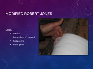 Modified Jones Method Bandaging principles and techniques | PPT
