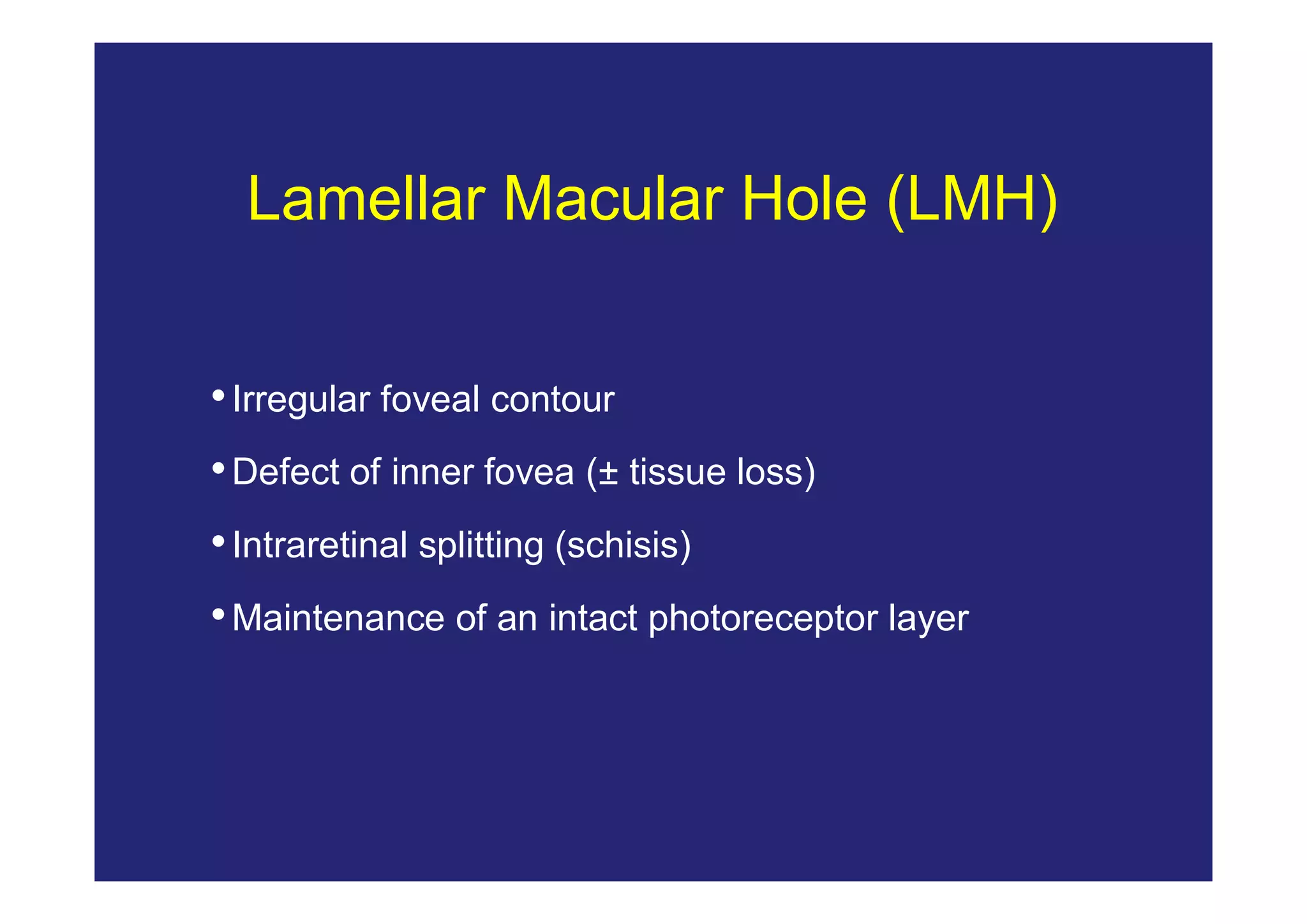 Bandello classifications of vitreo macular tractions | PDF